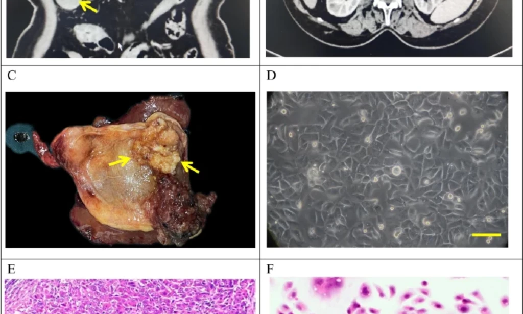 Establishment and characterization of a novel human gallbladder cancer cell line, GBC-X1